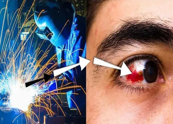 دلیل برق زدگی چشم در جوشکاری چیست؟ بلاگ آیا برقزدگی چشم میتواند عوارض طولانی مدت داشته باشد؟