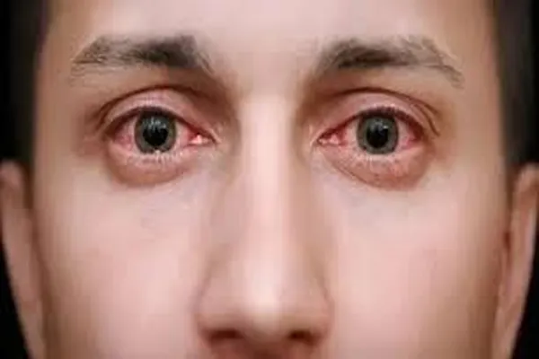 دلیل برق زدگی چشم در جوشکاری چیست؟ بلاگ برق زدگی چشم در جوشکاری